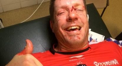 You can now add ‘horribly mangled finger’ to the lengthy list of Bakkies Botha injuries