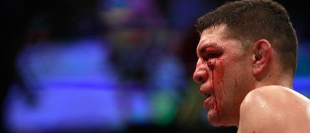Pic: Nick Diaz’ left eye is a mess after losing to Anderson Silva at UFC183