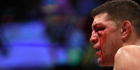 Pic: Nick Diaz’ left eye is a mess after losing to Anderson Silva at UFC183