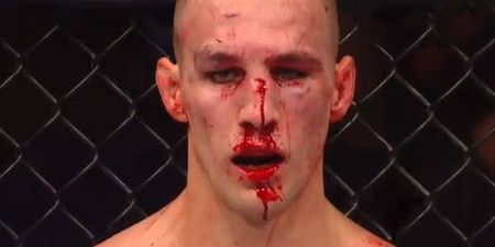 Rory MacDonald reveals that he has “kept breaking” his nose since the Robbie Lawler defeat