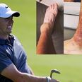 Rory McIlroy explains how his ankle will never be the same again after his footballing injury