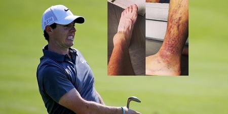 Rory McIlroy explains how his ankle will never be the same again after his footballing injury