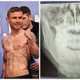 Scott Quigg fought eight rounds of his defeat to Carl Frampton with a very debilitating injury