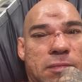GRAPHIC: After seven-hour surgery, ‘Cyborg’ Santos shares photographs of his fractured skull