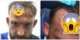 UPDATE: Steven Fletcher’s horrific head gash is not for the squeamish