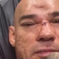 Despite fracturing skull in July, ‘Cyborg’ Santos intends to fight again before year is out