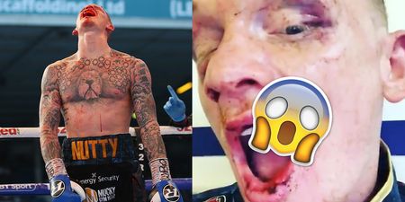 Boxer reveals the extent of horrific mouth injury suffered during fight